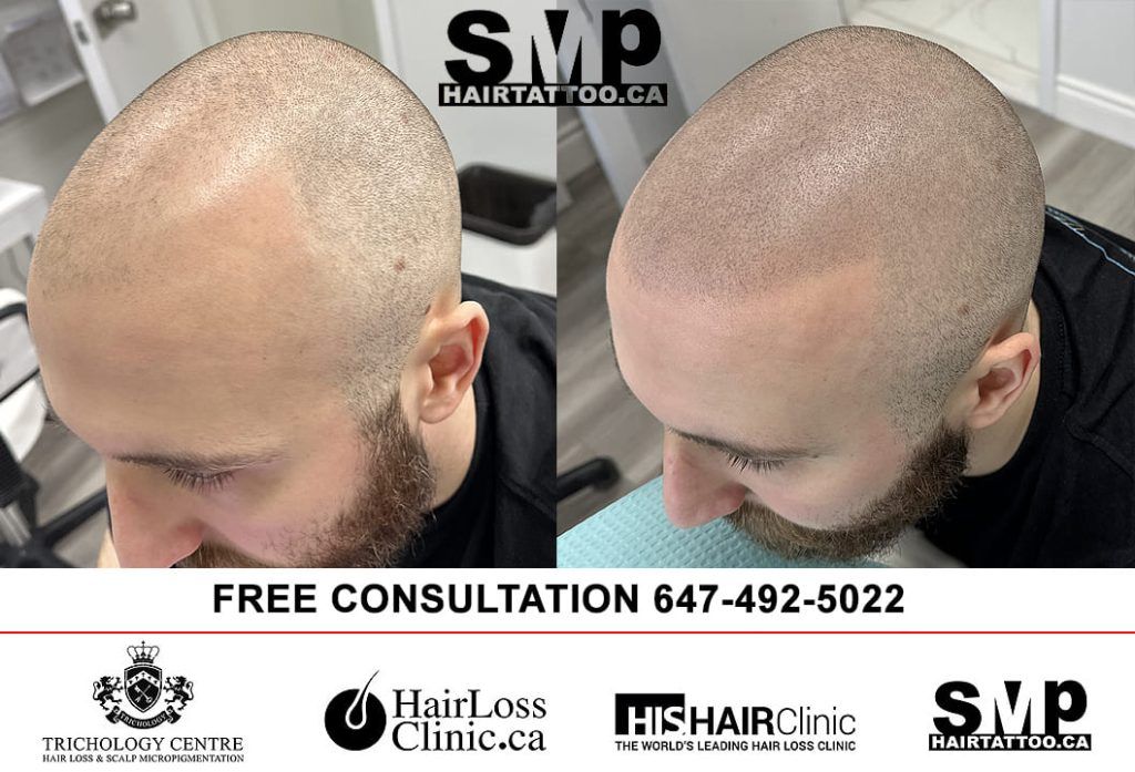 scalp-micropigmentation-Toronto-hair-tattoo-1024x697-1jpg