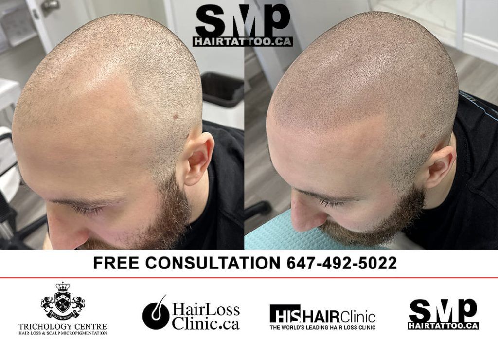 What is Tattoo Hair? Scalp Micropigmentation | HAIRTATTOO.CA