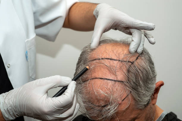 scalp micropigmentation - hair tattoo - micropigmentation