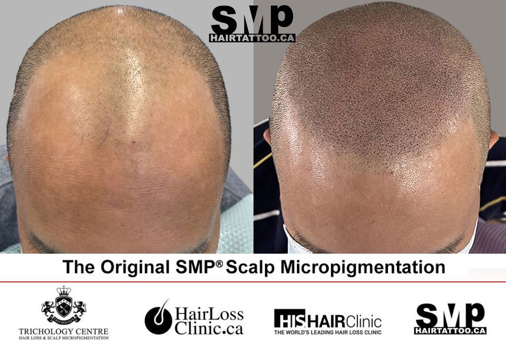 The-Original-Scalp-Micropigmentation-Toronto
