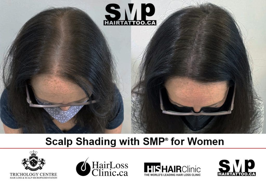 SMP-Alopecia-Treatment-for-Women-1-1024x697-1