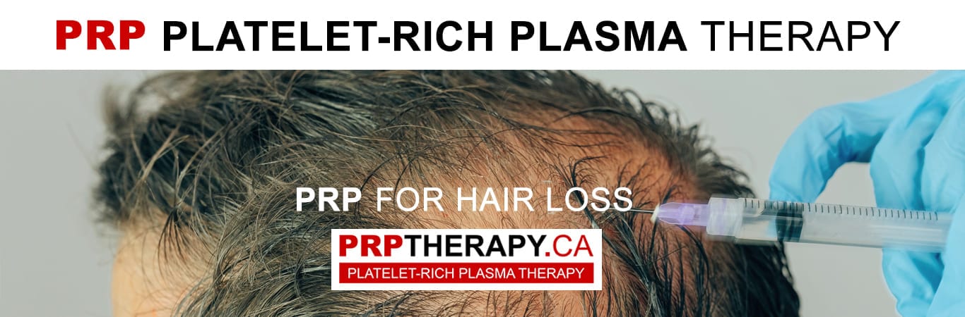 prp hair treatment