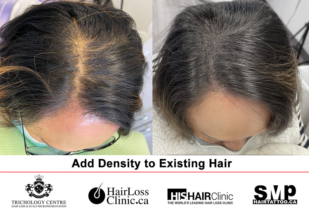 scalp micropigmentation for women