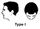 Norwood Scale Type 1