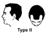 Norwood Scale Type 2