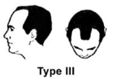 Norwood Scale Type 3