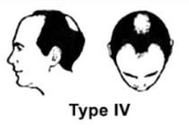 Norwood Scale Type 4