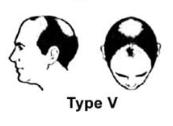 Norwood Scale Type 5