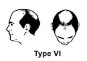 Norwood Scale Type 6