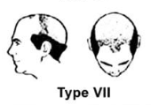 Norwood Scale Type 7