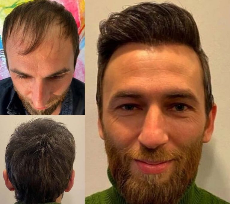 fue hair transplant turkey