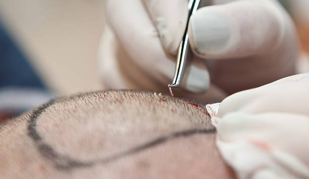 hair transplant in turkey