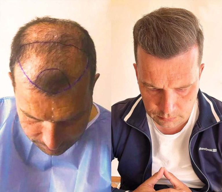 hair transplant turkey success rate