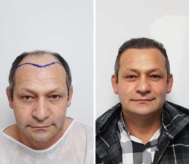 istanbul hair transplant clinics