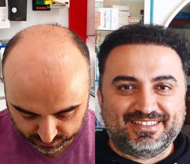 why is turkey the best for hair transplant