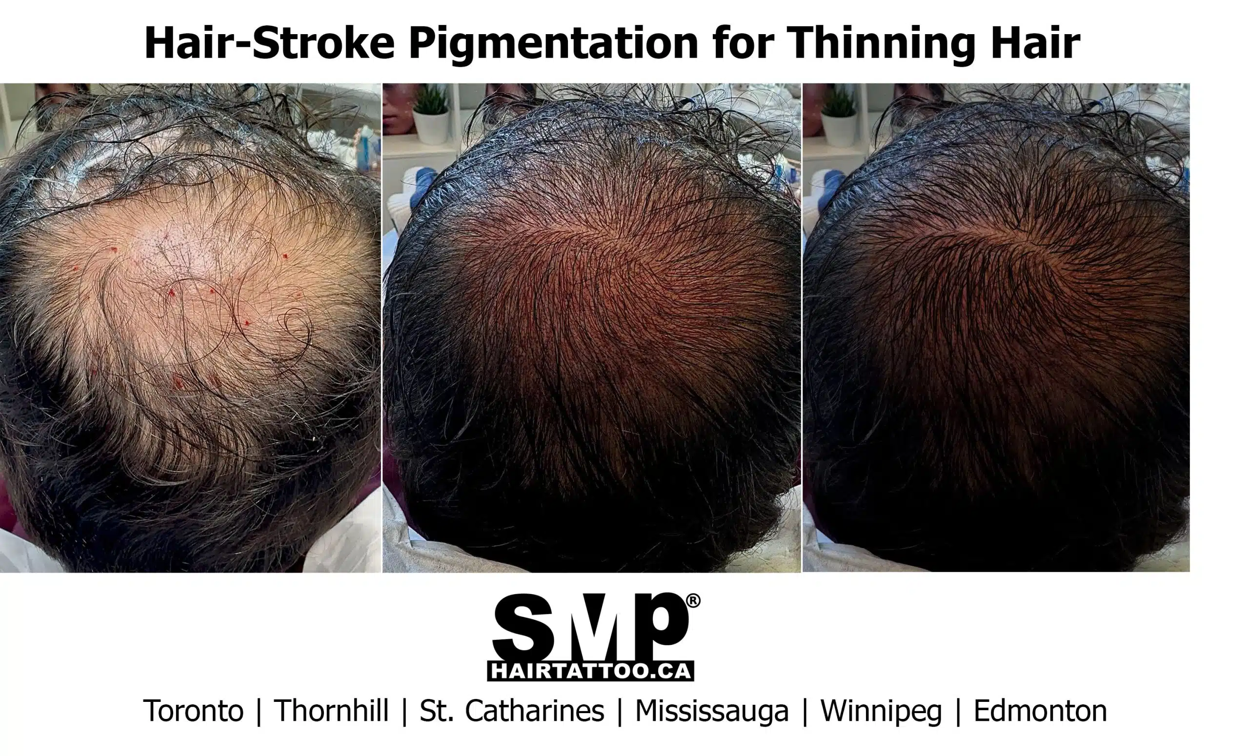 Hair-Stroke Pigmantation for Thinning Hair