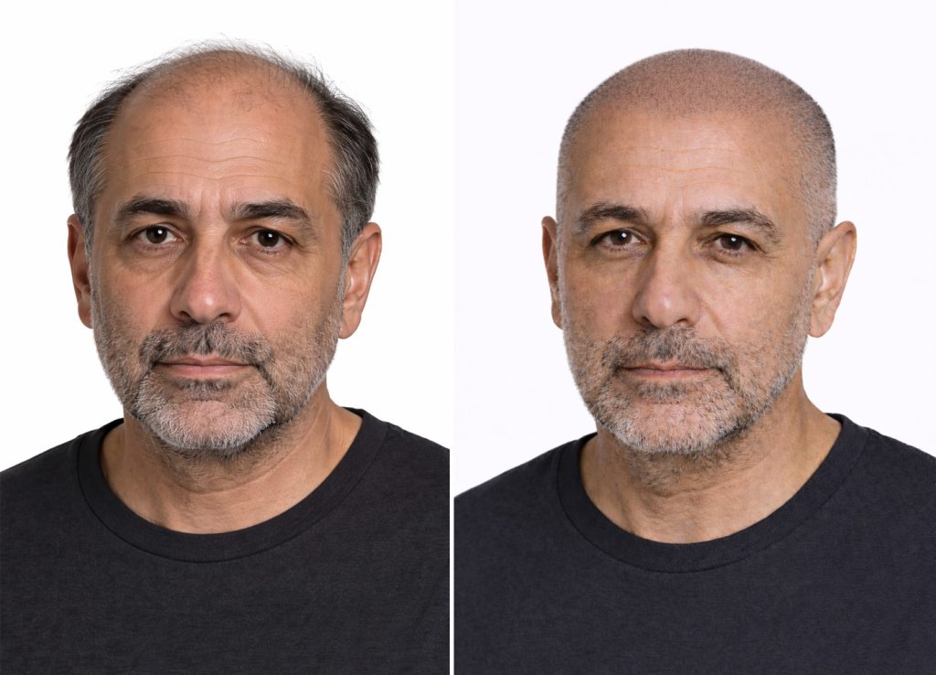 generate-before-and-after-for-scalp-micropigmentation